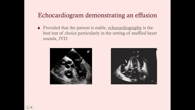 Pericardial Diseases - CRASH! Medical Review Series