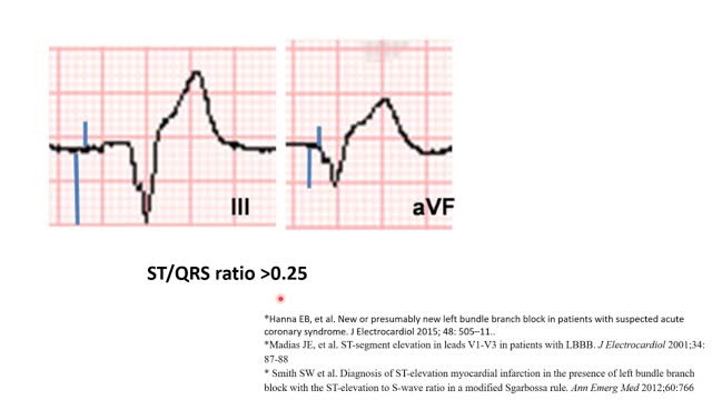 New LBBB: is it STEMI? Updated STEMI ECG criteria in LBBB (beyond Sgarbossa). Elias Hanna