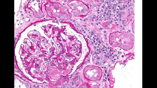 77-year-old man with a type 2 DM presents with worsening renal function and proteinuria