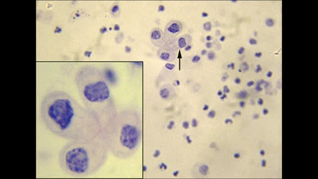 hematuria and AKI Post transplant