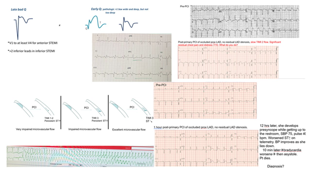 STEMI part 2- Questions and case scenarios- Elias Hanna