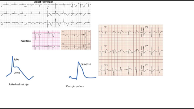 ST elevation on ECG, part 2: case studies