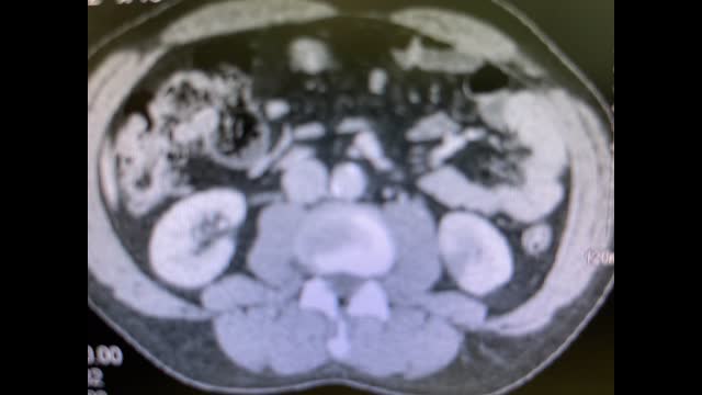 65 year old male with  left flank pain.
