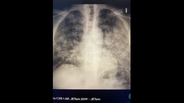 HIV patient with PNA and Worsening creatinine