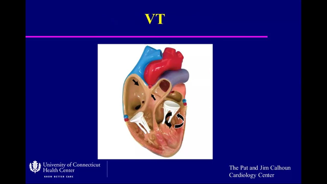 ECG Pearls: Ventricular Tachycardia (Heiko Schmitt, MD, PhD)