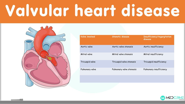 Valvular Heart Diseases: Classification, Causes, Pathophysiology, Diagnosis and Treatment