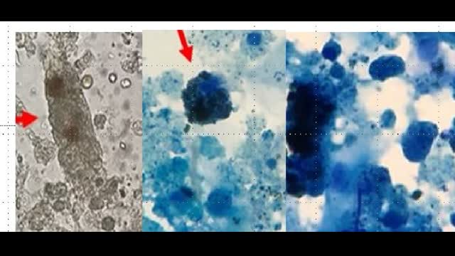 AKI following PNC exposure