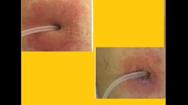 PD CATH EXIT SITE ERYTHEMA IN 39 YEAR OLD