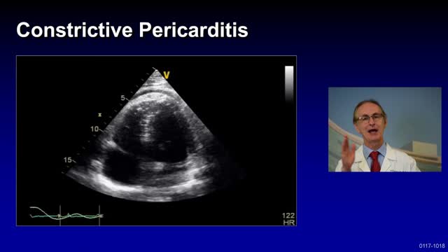 Treatment of Complicated Pericarditis