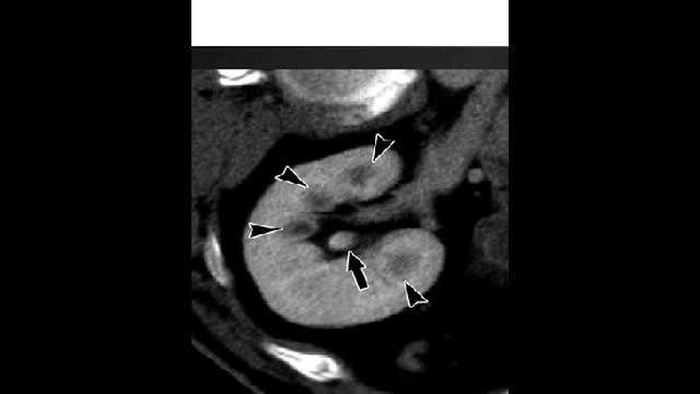 Diabetes patient with AKI, right flank pain and gross hematuria.
