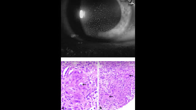 45 year old male with eye pain, blurred vision, renal insufficiency and proteinuria
