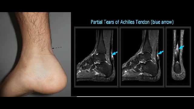 Achilles tendon rupture in a Hemodialysis partient